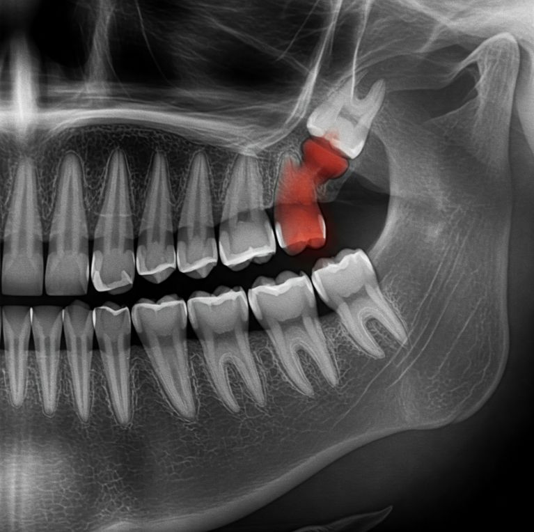 Radiografia Estrazione dente del Giudizio